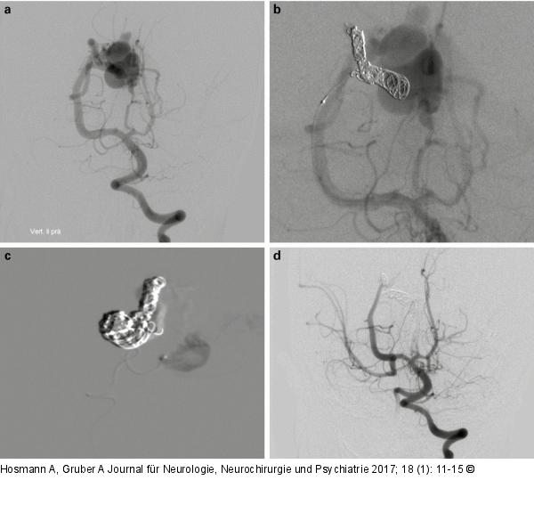 Embolisationstechniken