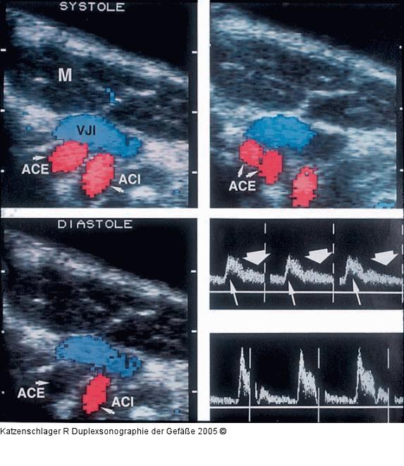 Duplexsonographie - Karotis