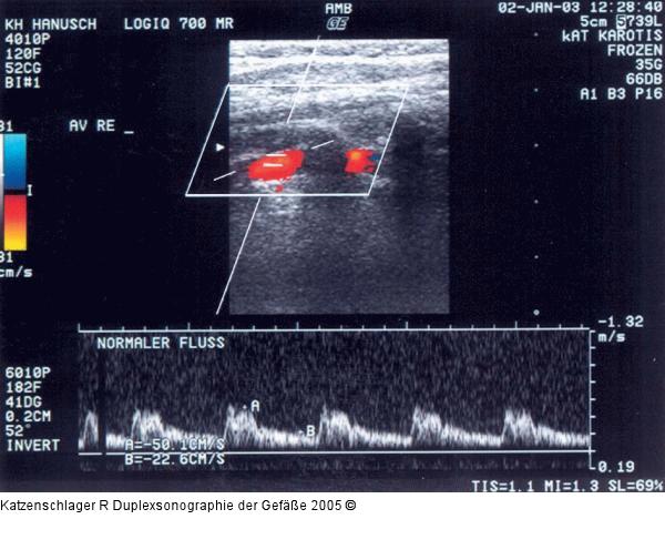 Duplexsonographie - A. vertebralis