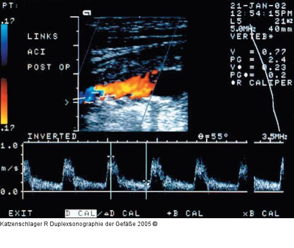 Duplexsonographie - Karotis