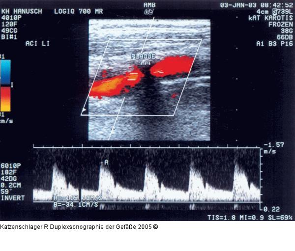 Duplexsonographie - Karotis