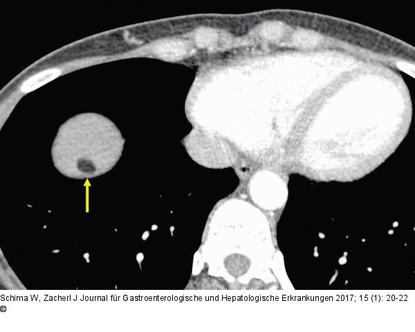 Hypodense Raumforderung