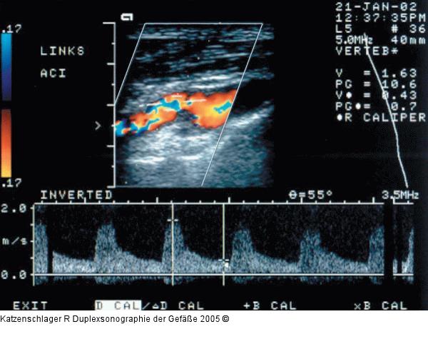Duplexsonographie - Karotis