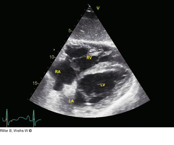 Rechtsventrikuläre Pumpfunktion