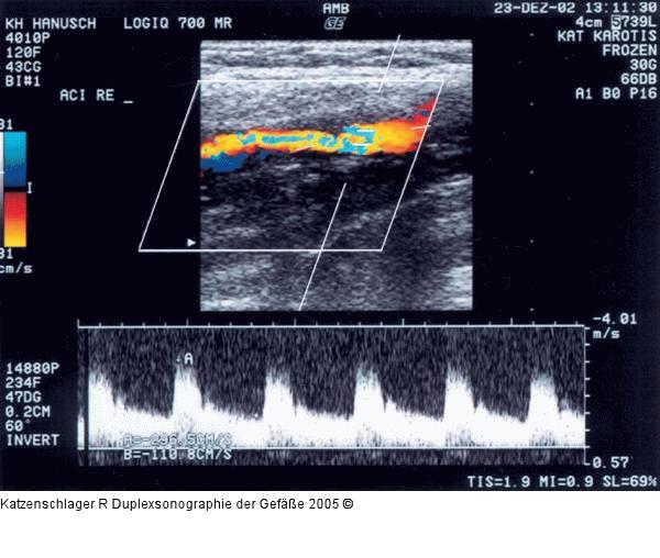Duplexsonographie - Karotis