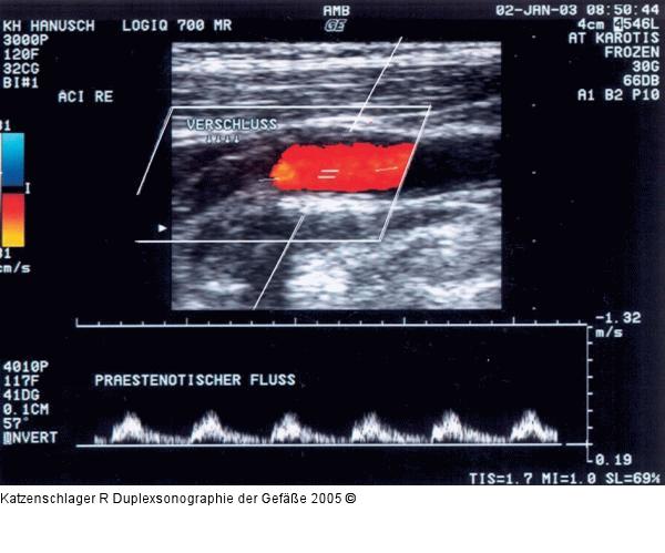 Duplexsonographie - Karotis