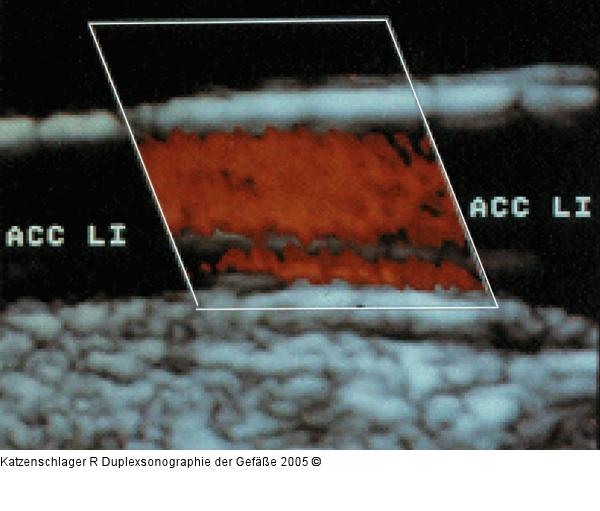 Duplexsonographie - Karotis