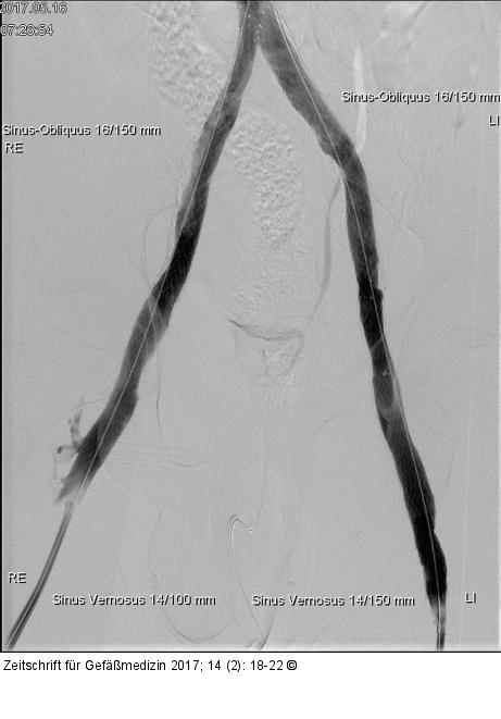 Angiographie - Stent