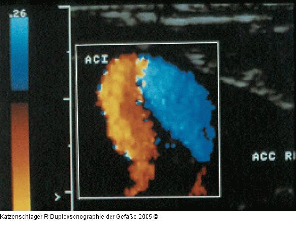 Duplexsonographie - Karotis