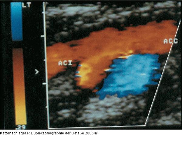 Duplexsonographie - Karotis