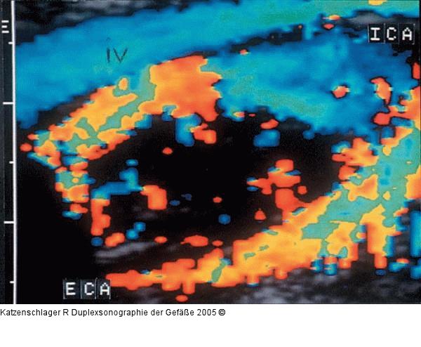 Duplexsonographie - Karotis