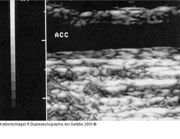 Duplexsonographie - Intima-Media