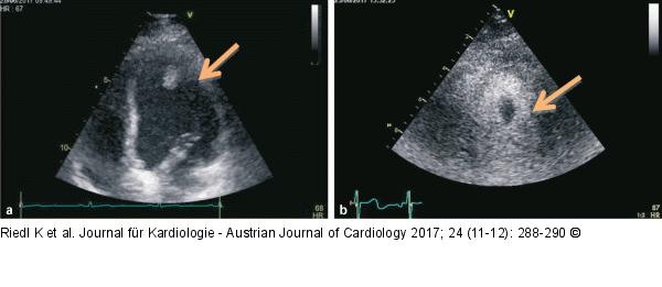 Transthorakale Echokardiographie