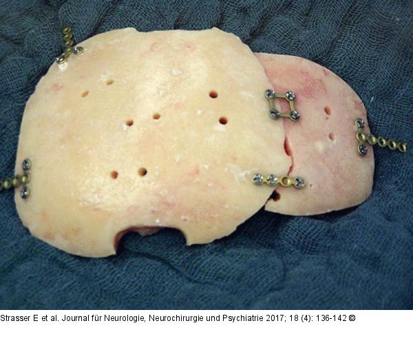 Autologer Knochendeckel