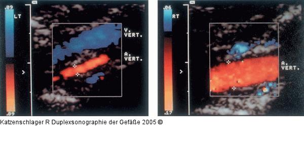 Duplexsonographie - Hypoplasie - Hyperplasie