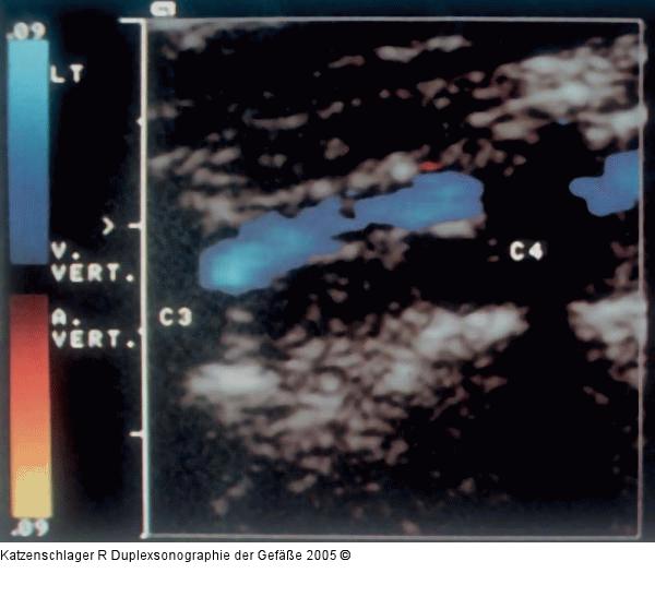 Duplexsonographie - A./V. vertebralis