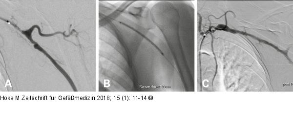Perkutane transluminale Angioplastie
