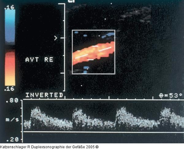 Duplexsonographie - A. vertebralis