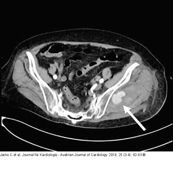 Persistierende Blutung