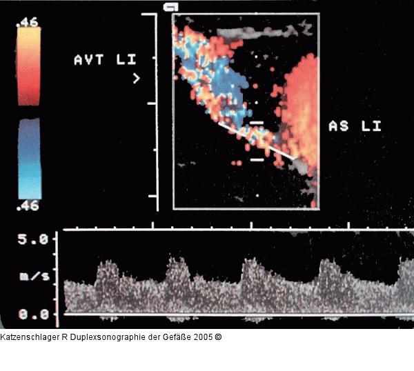 Duplexsonographie - A. vertebralis