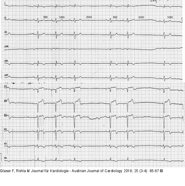 Sinusrhythmus mit Pausen