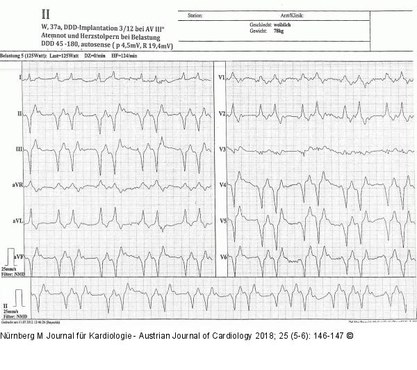 EKG - klinische Symptomatik
