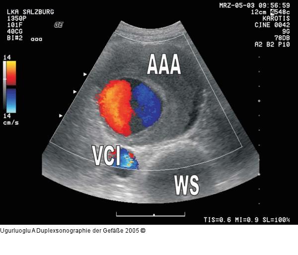 Duplexsonographie - Aneurysma
