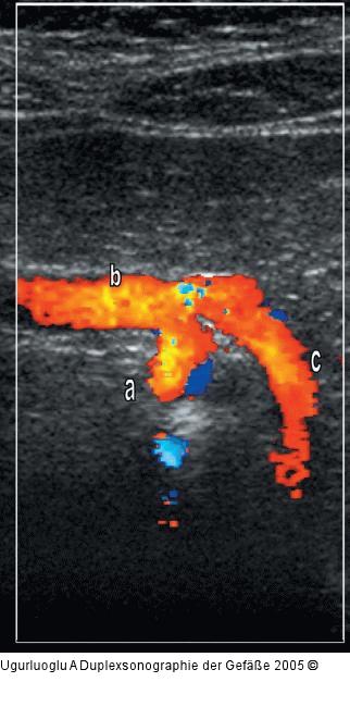 Duplexsonographie - T. coeliacus