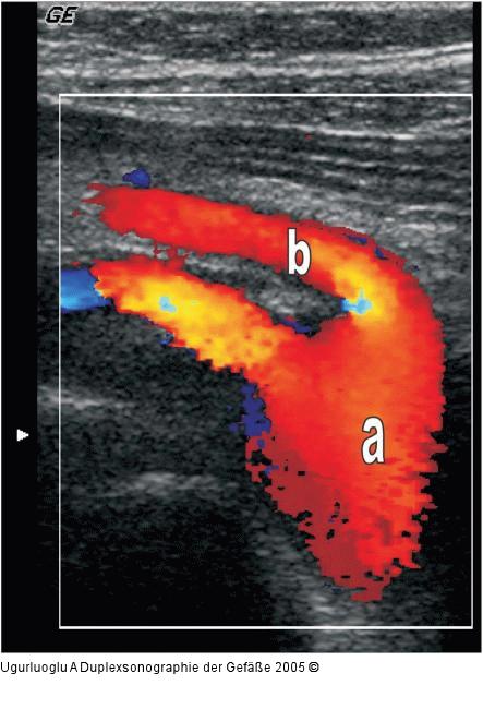Duplexsonographie - A. mesenterica sup.