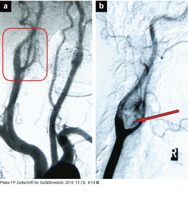 Digitale Subtraktionsangiographie