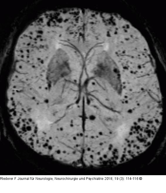 Signalauslöschungen