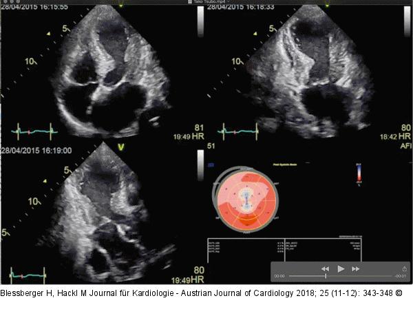 Linksventrikulärer longitudinaler Strain