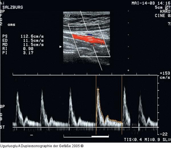 Duplexsonographie - A. mesenterica sup.