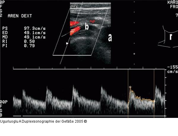 Duplexsonographie - Pulsdoppler