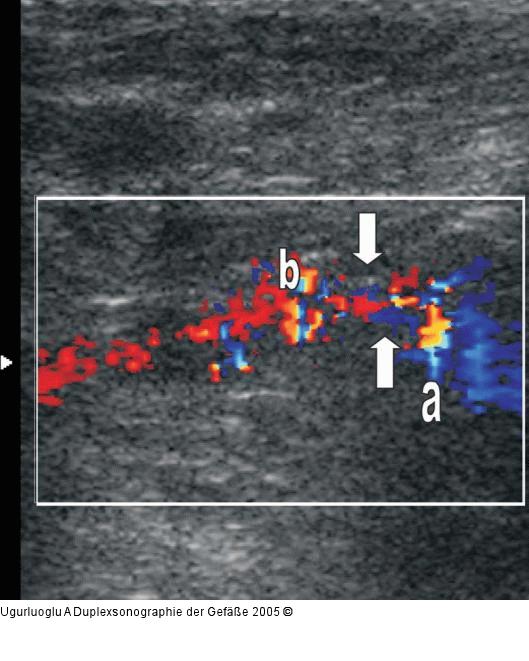 Duplexsonographie - Nierenarterienstenose