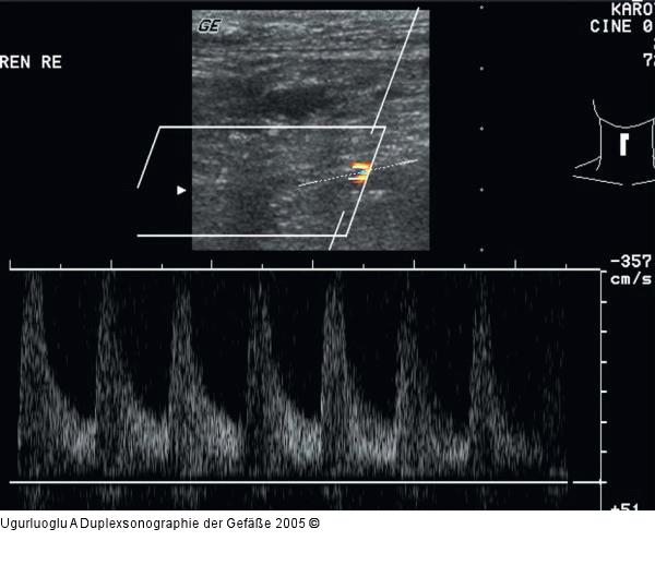 Duplexsonographie - Nierenarterienstenose