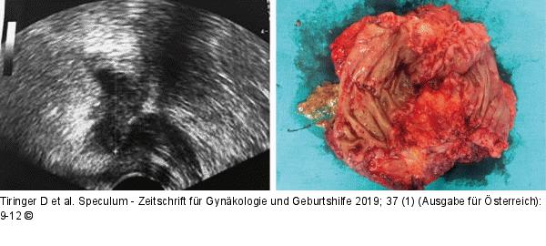 Tief infiltrierende Endometriose