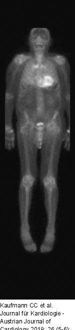 Amyloidose-Skelett-Szintigraphie