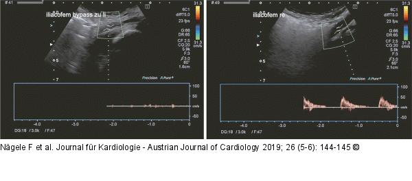 Ilio-femoraler Bypass