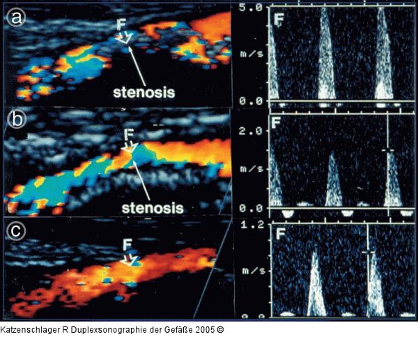 Duplexsonographie - A. subclavia