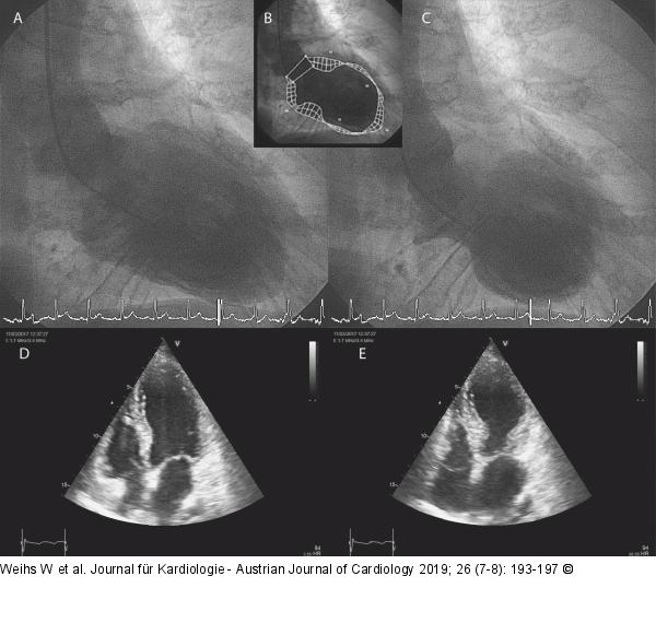 Laevokardiogramm - Echokardiogramm