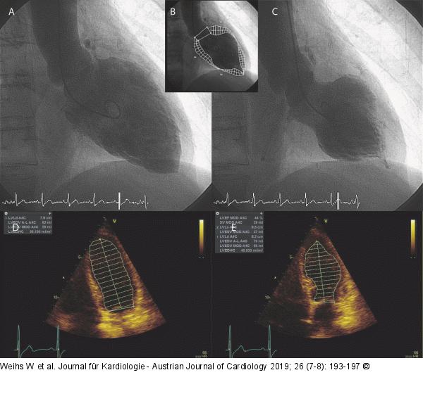 Laevokardiogramm - Echokardiogramm