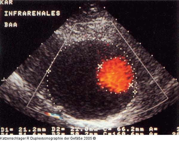 Duplexsonographie - A. abdominalis - Aneurysma