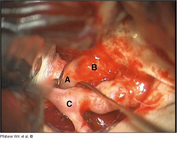 Intraoperativer Situs