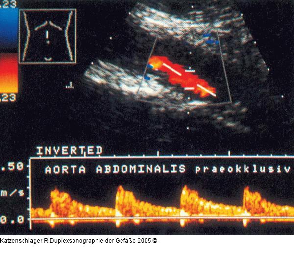 Duplexsonographie - A. abdominalis - Stenose