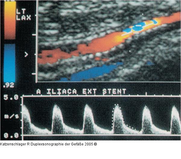 Duplexsonographie - A. iliaca externa - Restenose