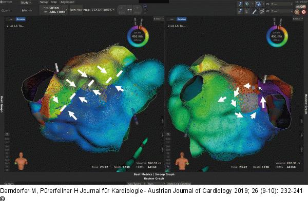 Ultra-hochauflösendes Aktivierungsmap