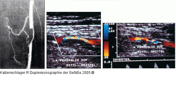 Duplexsonographie - A. femoralis - Stenose