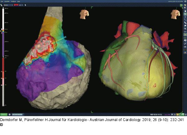 Epikardiales Voltagen-Map