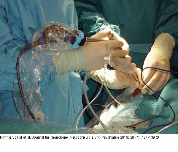 Neuroendoskopische Lavage